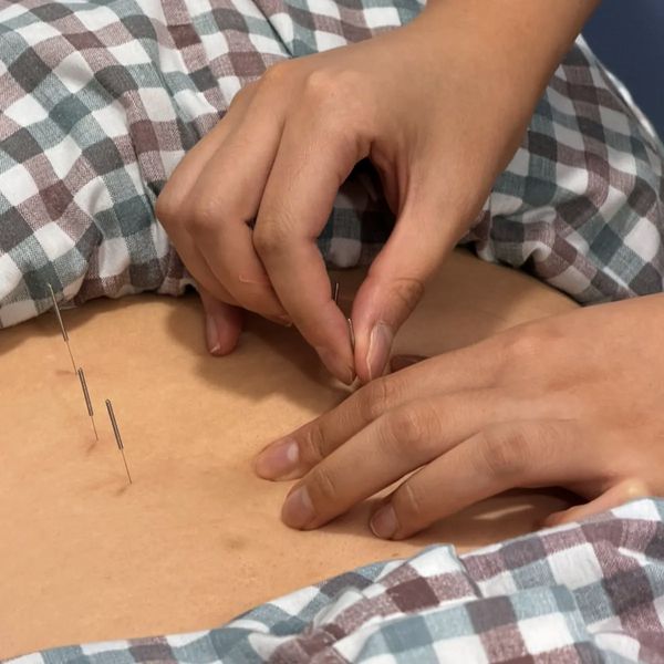 복부 침 치료