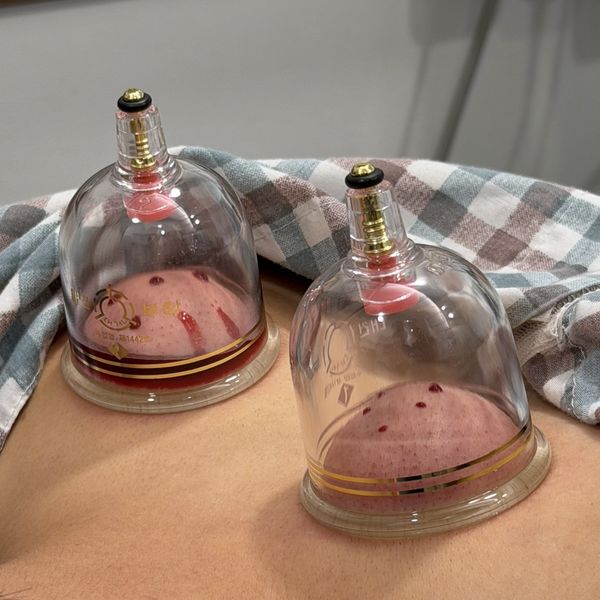 부항 치료 — 호랑이부부한의원